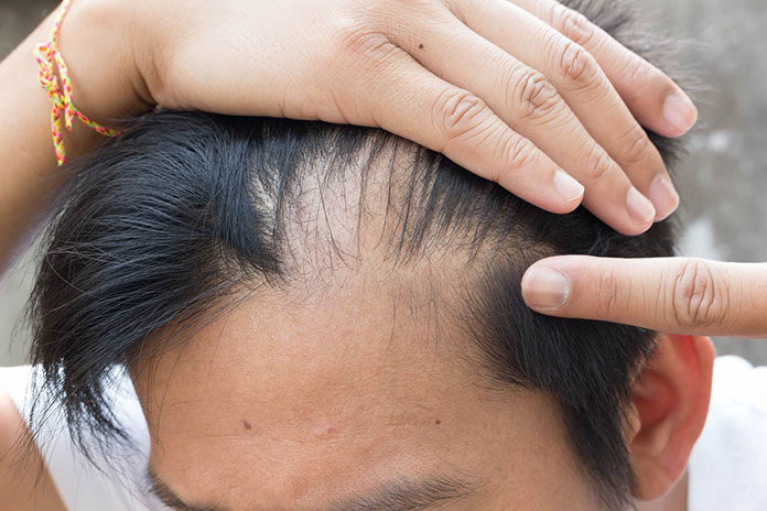 Jakie są rodzaje przeszczepów włosów?