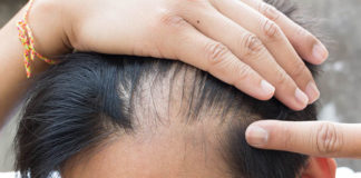 Jakie są rodzaje przeszczepów włosów?